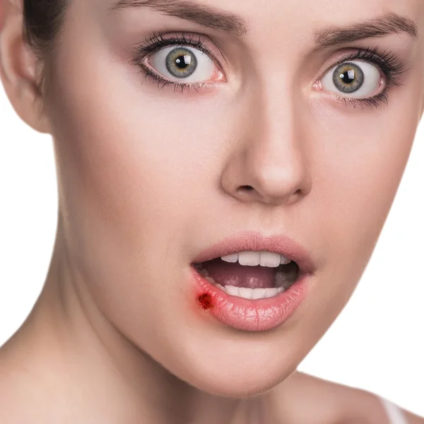 Sore on the female lips — Stock Photo, Image