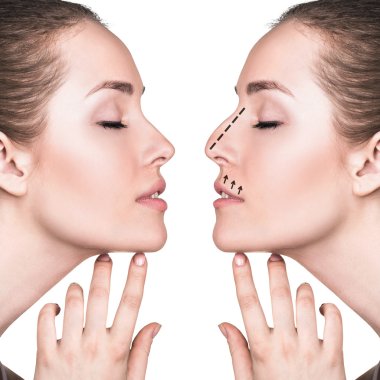 Kadın yüzü öncesi ve sonrası estetik burun ameliyatı