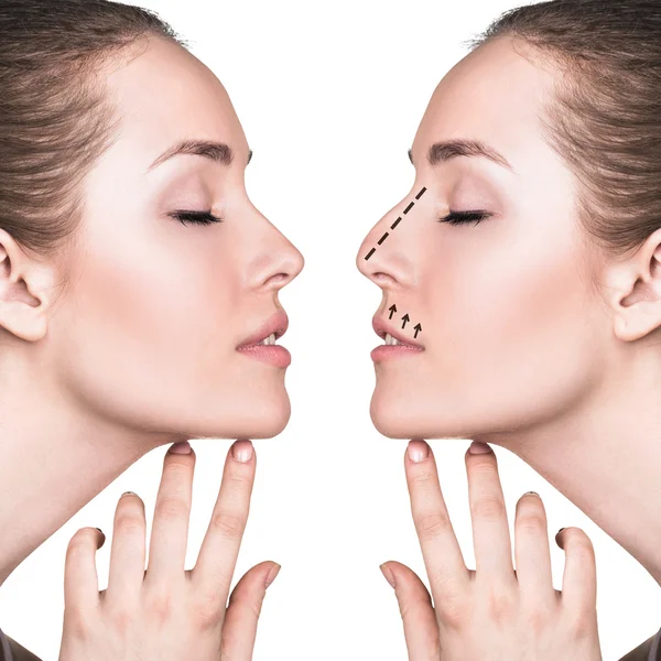 Viso femminile prima e dopo la chirurgia estetica del naso Fotografia Stock