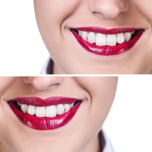 Labios antes y después de las inyecciones de relleno —  Fotos de Stock