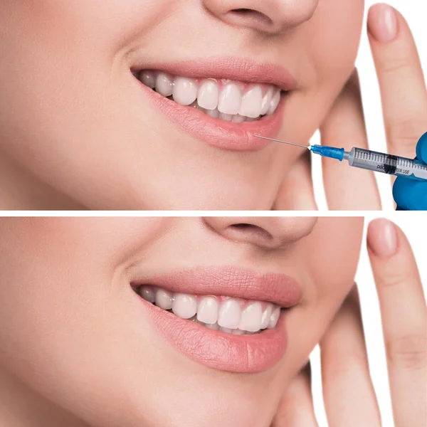 Lips before and after filler injections — Stock Photo, Image