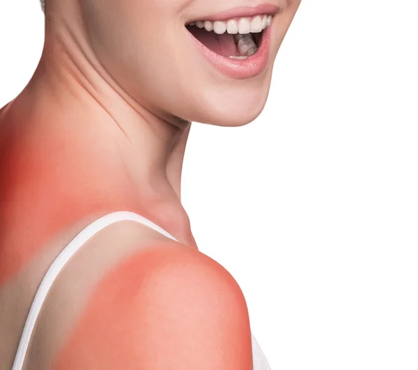 Жіночий плеча сонячних опіків — стокове фото