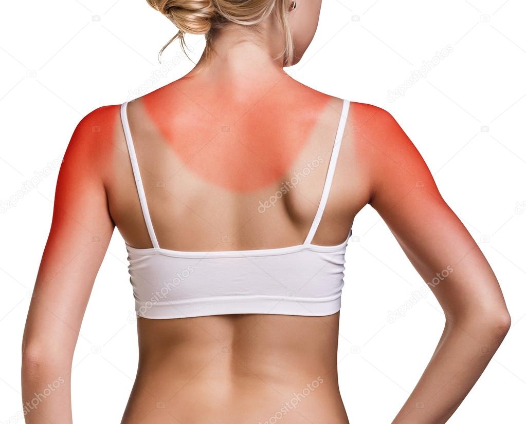 Girls with a sunburn naked