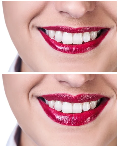 Labios antes y después de las inyecciones de relleno —  Fotos de Stock