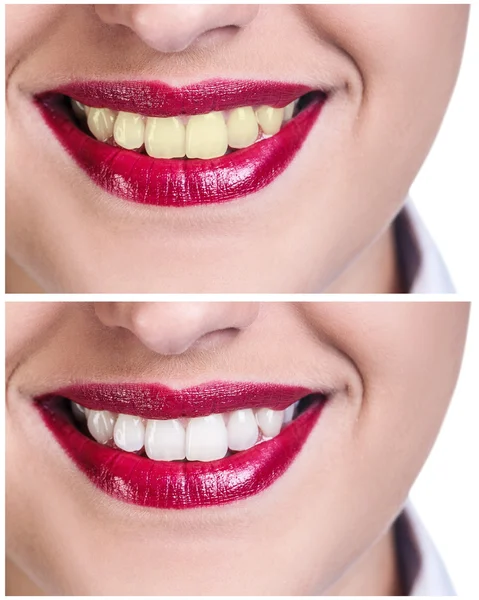 Denti prima e dopo il trattamento di sbiancamento — Foto Stock