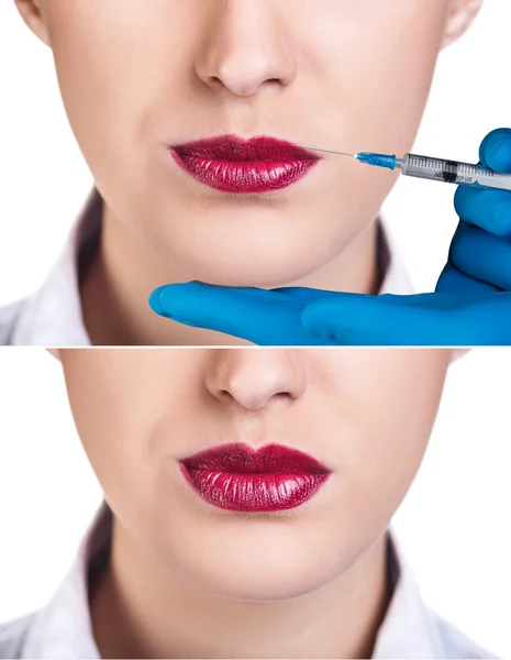 Vrouw krijgt injectie in haar lippen. — Stockfoto