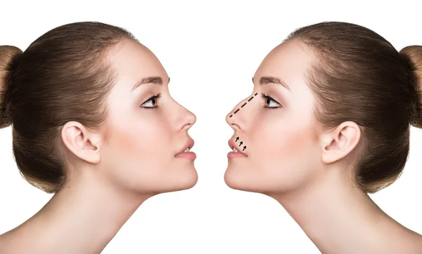 Mulher antes e depois da cirurgia estética do nariz — Fotografia de Stock