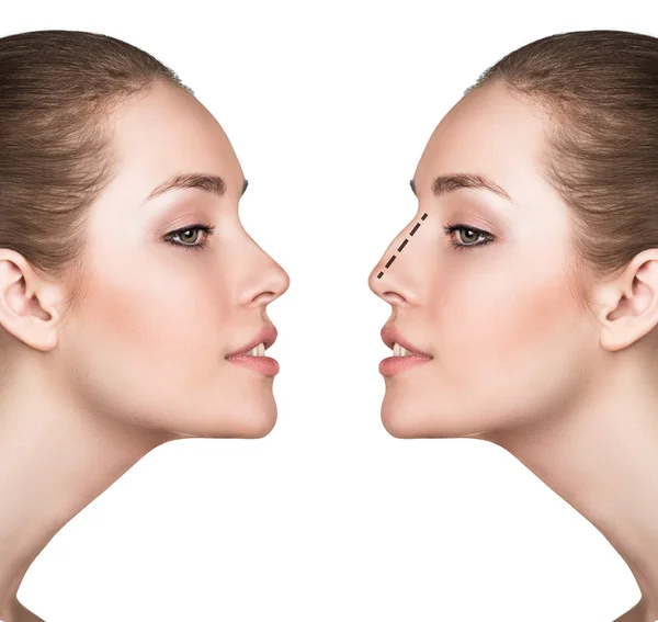 Woman before and after cosmetic nose surgery — Stock Photo, Image