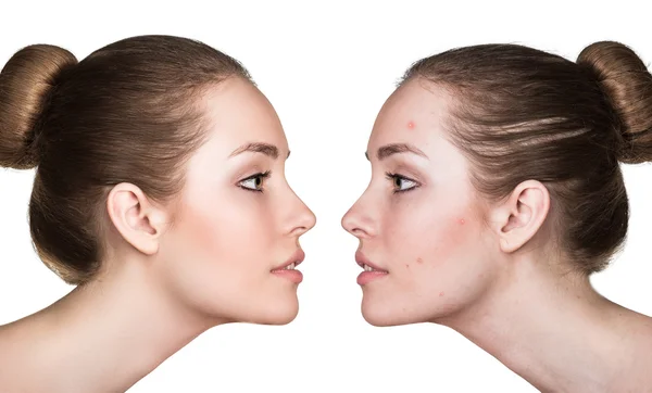 Comparison portrait of problematic skin — Stock Photo, Image