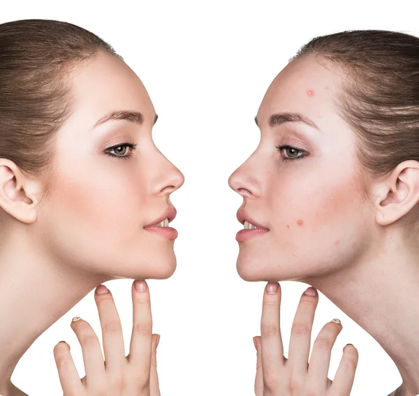 Comparison portrait of problematic skin — Stock Photo, Image