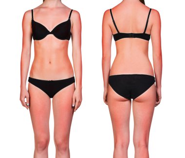 Güneş yanığı ile kadının vücut