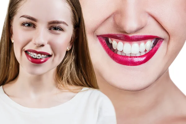 Dientes perfectos antes y después de los aparatos ortopédicos —  Fotos de Stock