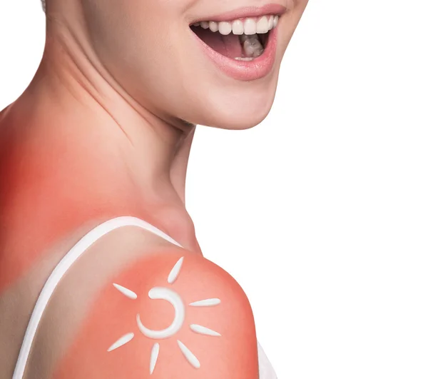 Cream on the shoulder of woman with sunburn — Stock Photo, Image