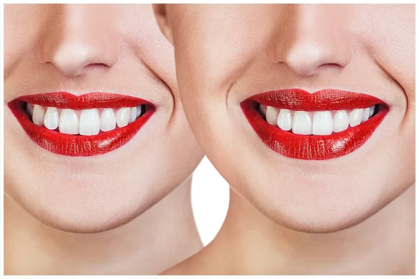 Lábios vermelhos antes e depois das injeções de enchimento — Fotografia de Stock