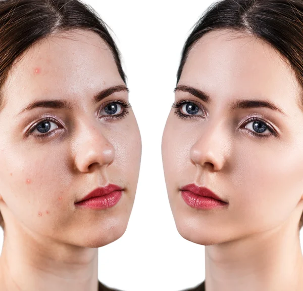 Woman with problem skin on her face — Stock Photo, Image