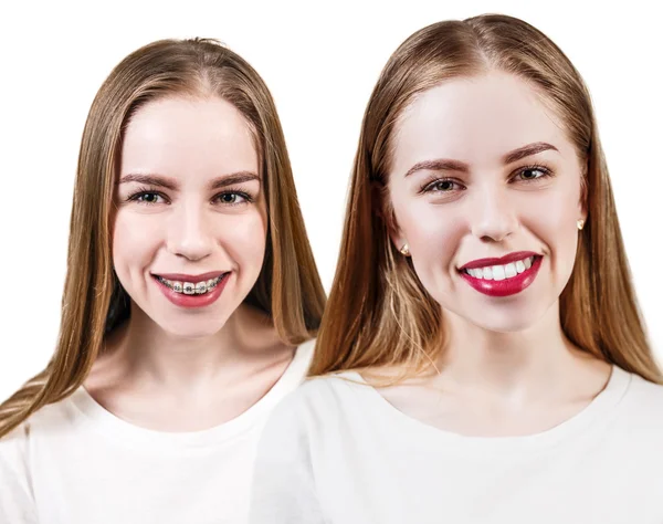 완벽 한 치아 교정기 전후 — 스톡 사진