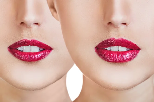 Lábios vermelhos antes e depois das injeções de enchimento — Fotografia de Stock