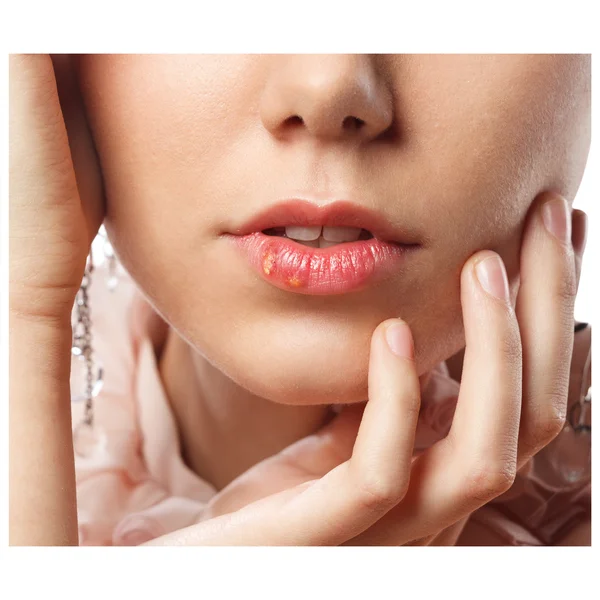 Beautiful lips infected herpes virus — Stock Photo, Image