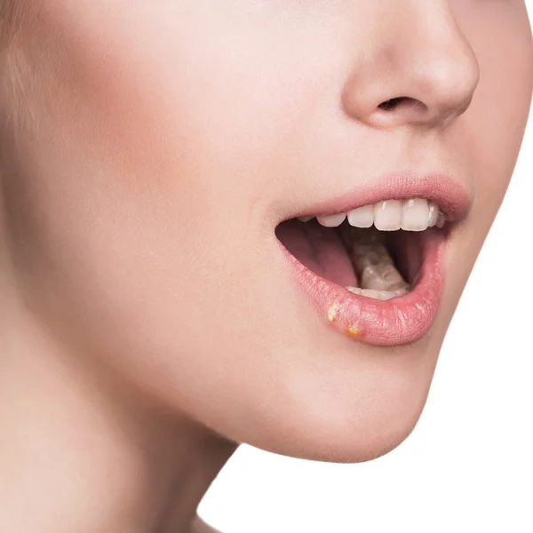 Schöne Lippen infizierten Herpes-Virus — Stockfoto