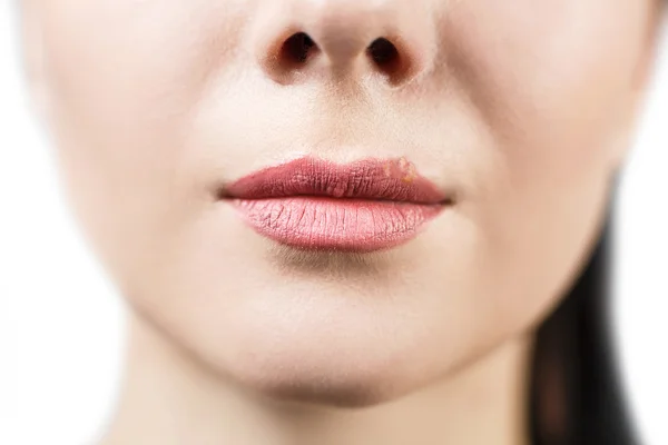 Hermosos labios infectados por el virus del herpes — Foto de Stock