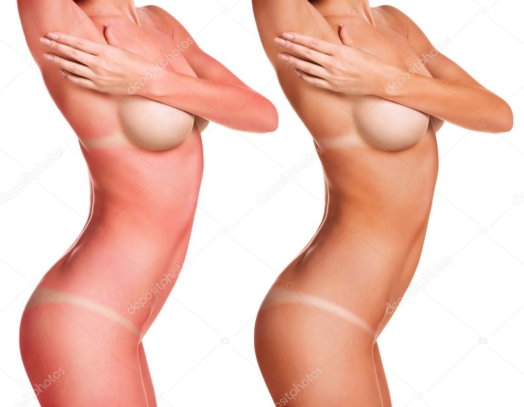 Güneş yanığı Güneş yanığı