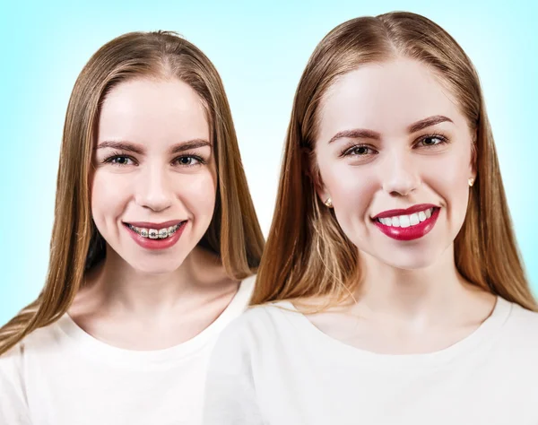 Dokonalé zuby před a po složené závorky — Stock fotografie