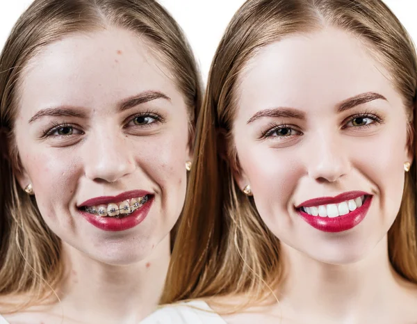 Dokonalé zuby před a po složené závorky — Stock fotografie