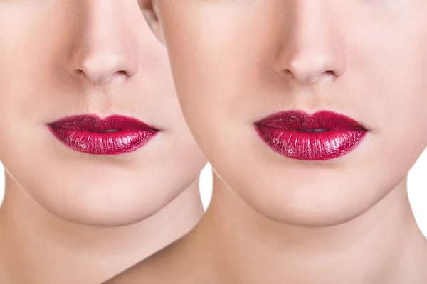 Iniezioni di riempitivo per labbra prima e dopo . — Foto Stock