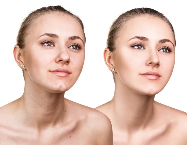 Mujer con problemas de piel en la cara — Foto de Stock