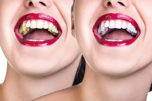 Antes e depois de clarear os dentes . — Fotografia de Stock