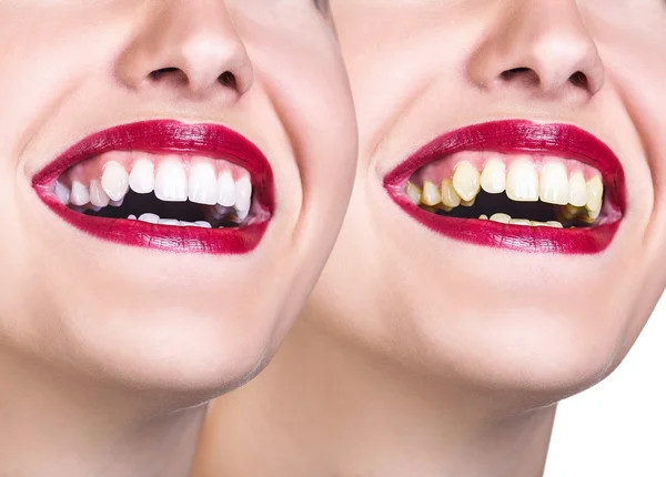 Vor und nach dem Bleaching der Zähne. — Stockfoto