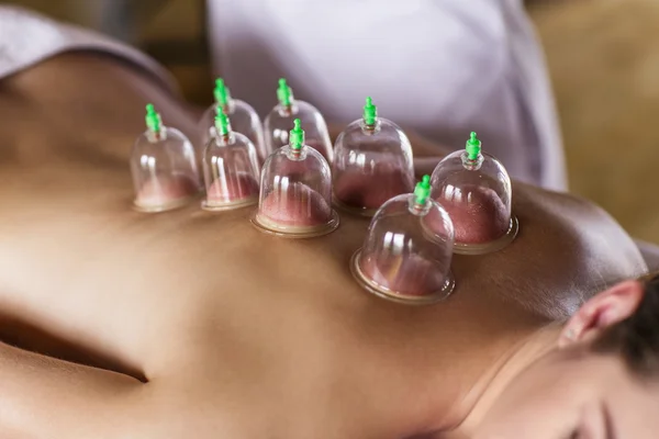 Woman with cupping treatment on back — Stock Photo, Image