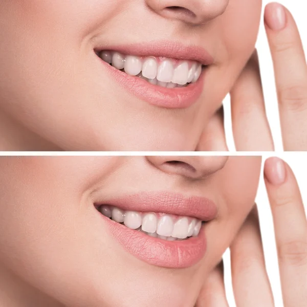 Female lips before and after augmentation — Stock Photo, Image