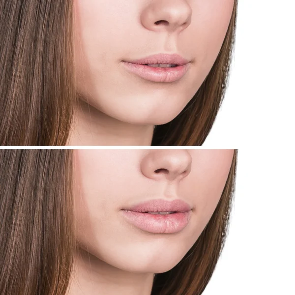 Vrouwelijke lippen voor en na vergroting — Stockfoto