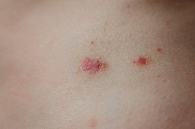 Sedef kabuğu derisi. Sedef hastalığı, deriyi etkileyen bir otoimmün hastalıktır. Cilt iltihabına neden olur. Sedef hastalığı ve diğer deri hastalıkları.