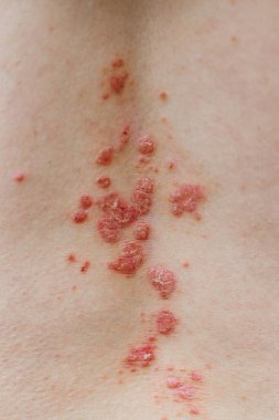 Sedef kabuğu derisi. Sedef hastalığı, deriyi etkileyen bir otoimmün hastalıktır. Cilt iltihabına neden olur. Egzama ve mantar, plaket, kızarıklık ve yamalar gibi diğer cilt koşulları