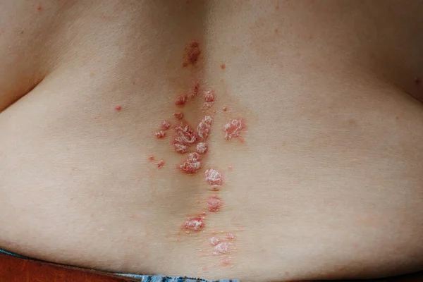 발진과 가려운 건조 한 피부 문제가 있는 여성의 뒷모습. — 스톡 사진