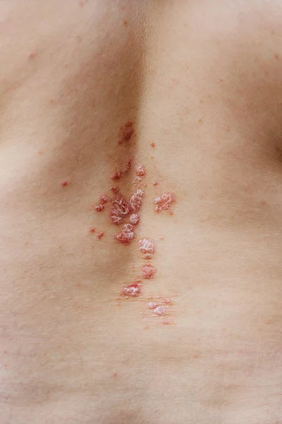 발진과 가려운 건조 한 피부 문제가 있는 여성의 뒷모습. — 스톡 사진