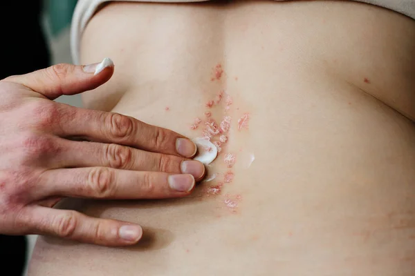 Tangan wanita melumasi rusak, kulit alergi di punggung oleh obat penyembuhan. Psoriasis dan penyakit kulit lainnya — Stok Foto