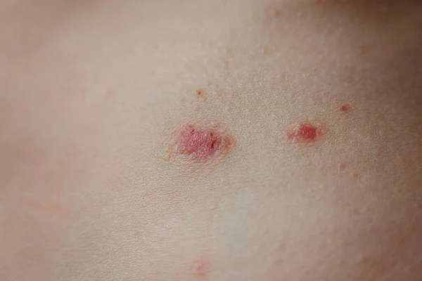 Psoriasis vulgar piel. La psoriasis es una enfermedad autoinmune que afecta a la piel y causa inflamación de la piel enrojecida y escamosa. Psoriasis y otras enfermedades de la piel — Foto de Stock