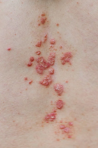 Psoriasis vulgaris huid. Psoriasis is een auto-immuunziekte die de huid aantast en rode en schilferige huidontsteking veroorzaakt. Eczeem en andere huidaandoeningen zoals schimmel, plaque, huiduitslag en pleisters — Stockfoto
