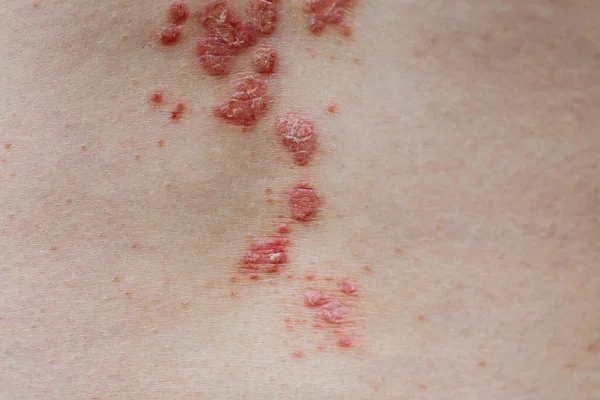 Kulit Psoriasis vulgaris. Psoriasis adalah penyakit autoimun yang mempengaruhi kulit menyebabkan peradangan kulit merah dan bersisik. Eksim dan kondisi kulit lainnya seperti jamur, plak, ruam dan tambalan — Stok Foto