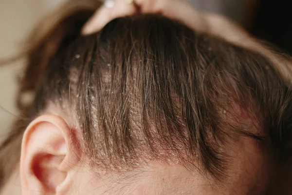 Psoríase Vulgar, doença psoriática da pele no cabelo, manchas de pele são típicos vermelho, coceira, e escamosa, macro com foco estreito — Fotografia de Stock