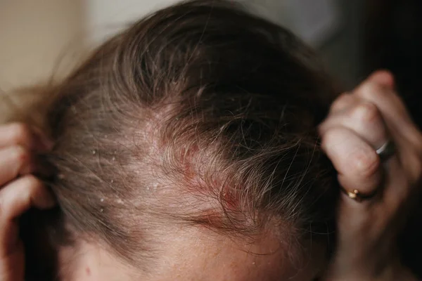 Psoríase Vulgar, doença psoriática da pele no cabelo, manchas de pele são típicos vermelho, coceira, e escamosa, macro com foco estreito — Fotografia de Stock