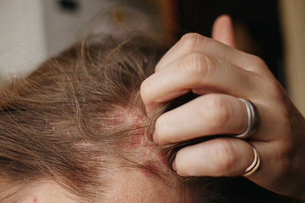 Псориаз Вульгарис, псориатическое заболевание кожи в волосах головы, участки кожи типично красные, чешуйчатые и чешуйчатые. Женщина яростно чешет голову