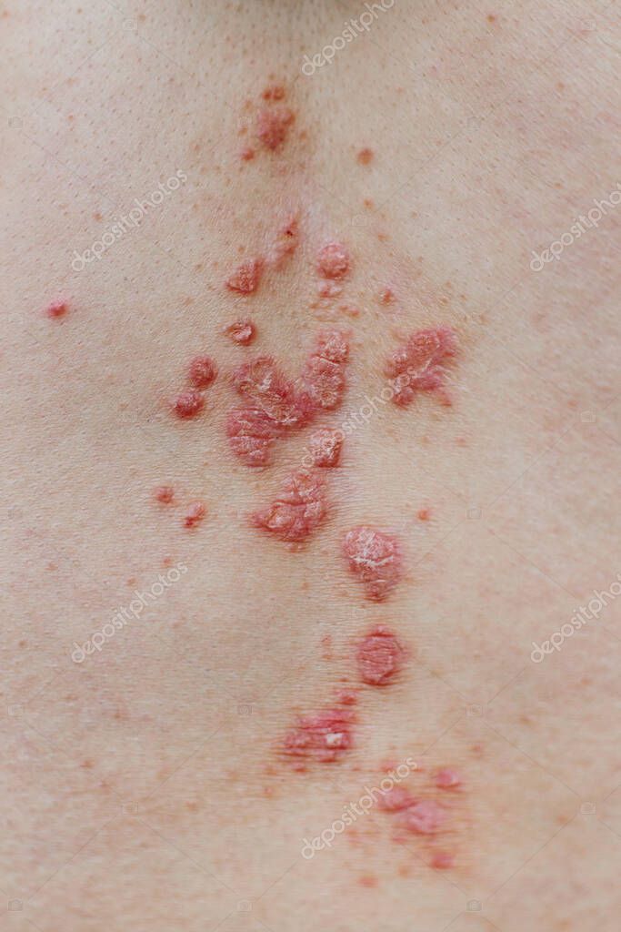 Psoriasis vulgar piel. La psoriasis es una enfermedad autoinmune que
