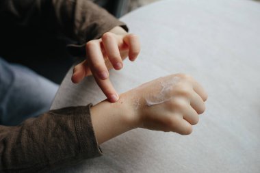 A small child smears redness on the hand with baby cream. The concept of treatment and skin care with cream, frostbite and peeling skin. Allergy problem clipart