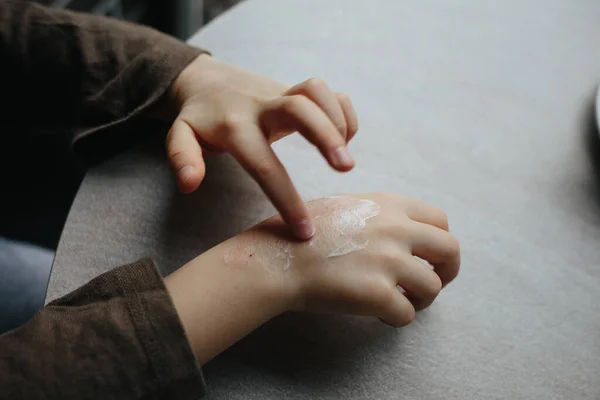Uma criança pequena mancha vermelhidão na mão com creme de bebê. O conceito de tratamento e cuidados com a pele com creme, congelamento e casca da pele. Problemas de alergia — Fotografia de Stock