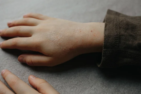 Mão de crianças com dermatite atópica. eczema na mão. psoríase em mãos de crianças — Fotografia de Stock