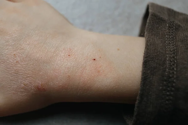 Gyermekek kéz atópiás dermatitis. ekcéma a kéznél. pikkelysömör gyermekek kezén — Stock Fotó